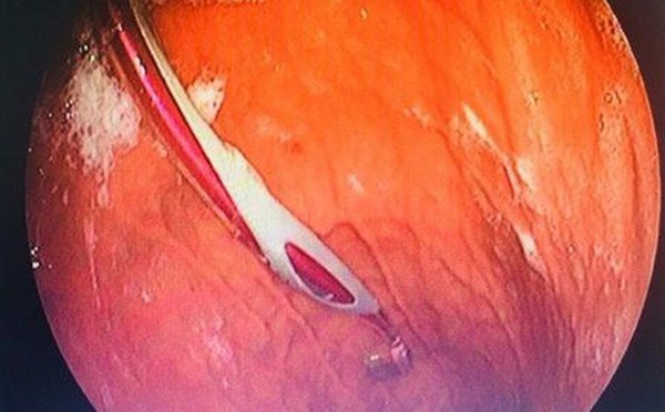 Hy hữu: hóc xương cá dùng bàn chải đánh răng giải cứu rồi nuốt cả vào bụng-2