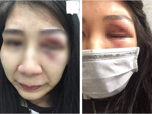 Xót xa gương mặt tím bầm của cô vợ bị chồng bạo hành, ép phá thai vì nhỡ kế hoạch-1