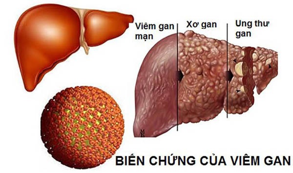 Giám đốc 40 tuổi bị ung thư gan vì làm 4 việc trong thời gian dài-3