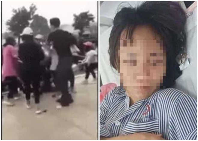 Nữ sinh Quảng Ninh tiết lộ lý do bị đánh hội đồng dẫn đến tụ máu ở đầu, phải nhập viện-1