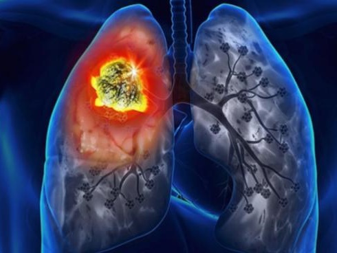 Chỉ vì một hiểu lầm tai hại, cô gái 25 tuổi không được điều trị và tử vong vì ung thư phổi: Nắm 8 dấu hiệu này để kịp thời phát hiện bệnh-3