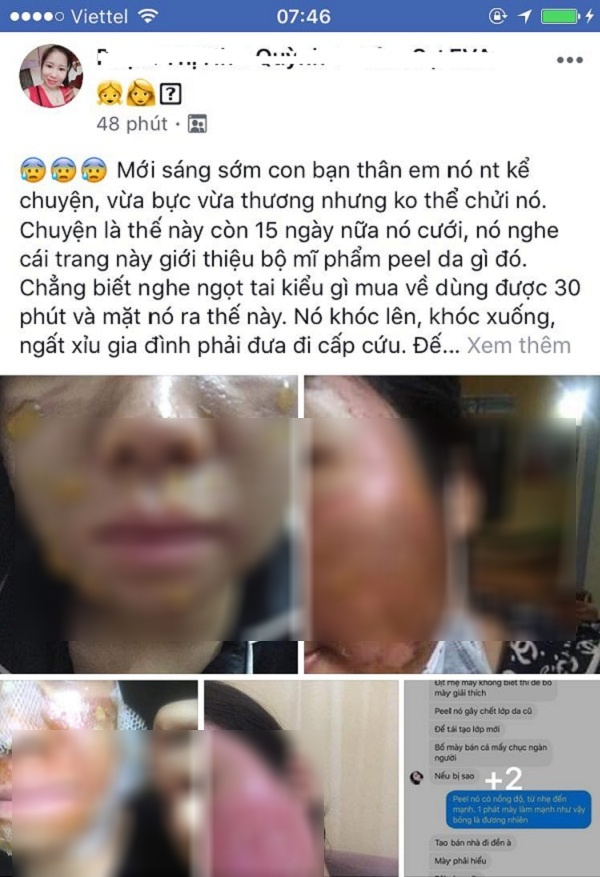 Sắp cưới, cô gái dại dột mua mỹ phẩm về peel da tân trang nhan sắc, không ngờ mặt sần sùi, lở loét đáng sợ-1