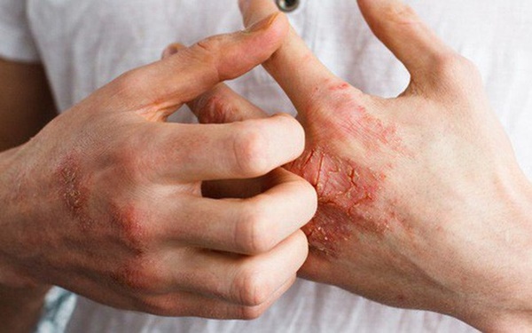 Bé 11 tuổi bị dị ứng thực phẩm đã tử vong sau khi hít mùi cá nấu-3