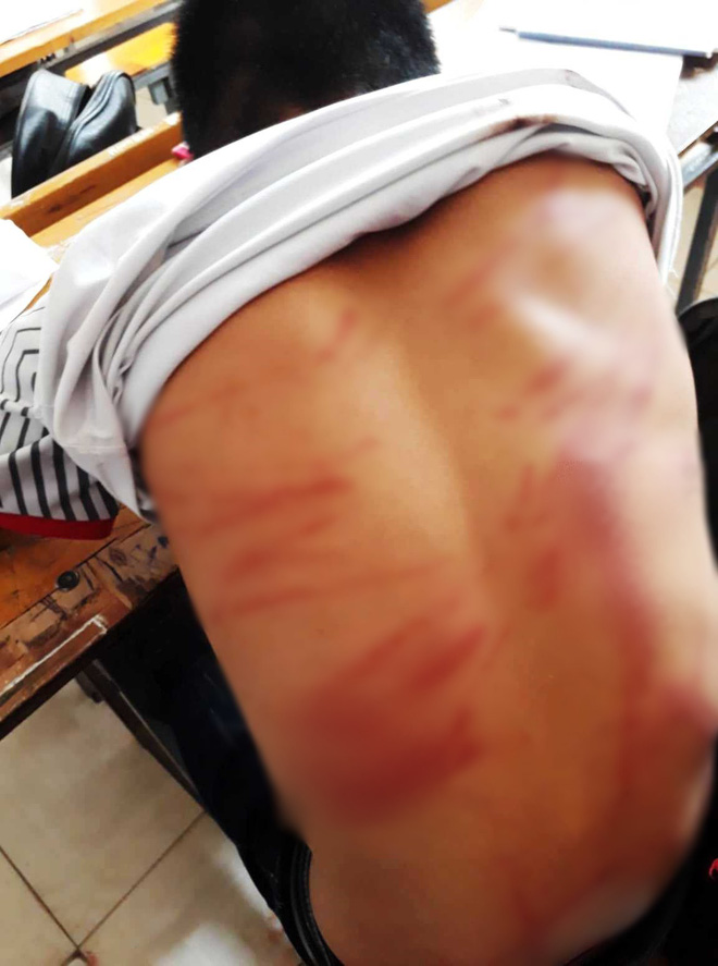 Phẫn nộ hình ảnh học sinh lớp 8 bị bố đánh bầm dập” ngất xỉu tại lớp, nhà trường phải đưa đi cấp cứu-2