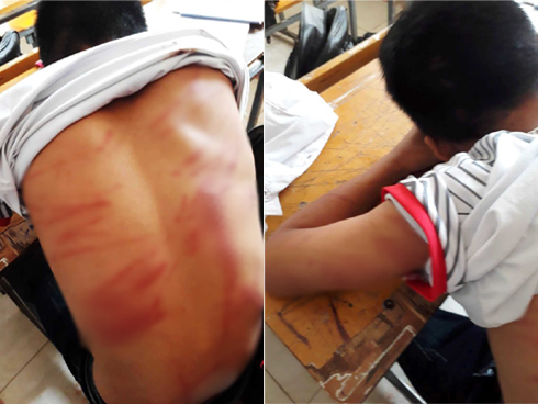 Vụ nam sinh lớp 8 bị bố đánh dã man phải nhập viện: Vợ cũ tố chồng cũng từng đánh mình gãy tay và dọa giết-4