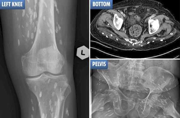 Ảnh kinh dị: Hàng trăm trứng sán dây trong não và cơ thể bệnh nhân-1