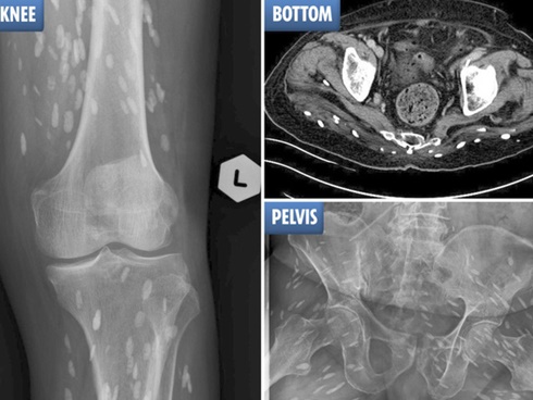 Bác sĩ phát hiện 700 con sán dây làm tổ, gây tổn thương trong não, ngực và phổi của một người đàn ông ăn thịt lợn chưa chín-7