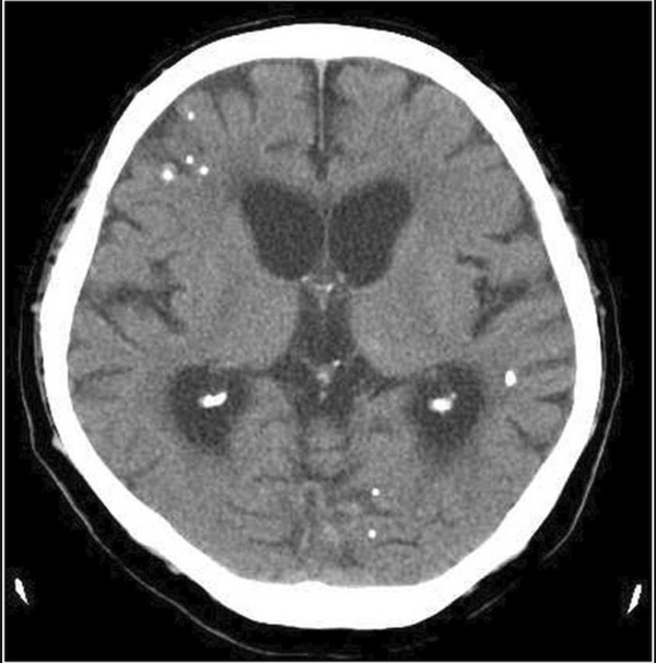 Ảnh kinh dị: Hàng trăm trứng sán dây trong não và cơ thể bệnh nhân-3