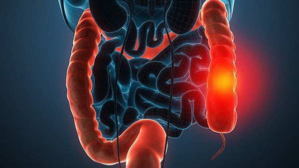 Chủ quan với chứng táo bón khiến cô gái này qua đời khi mới 33 tuổi-1