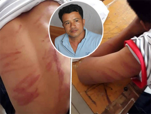 Bố đánh con trai lớp 8 nhập viện: Cháu bé có 79 vết thương, vẫn hoảng loạn tinh thần-3