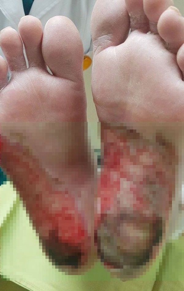 Dùng muối đá Himalaya bị hoại tử chân và những nguy hiểm khủng khiếp-2