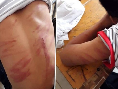 Bố đánh con trai lớp 8 nhập viện: Cháu bé có 79 vết thương, vẫn hoảng loạn tinh thần
