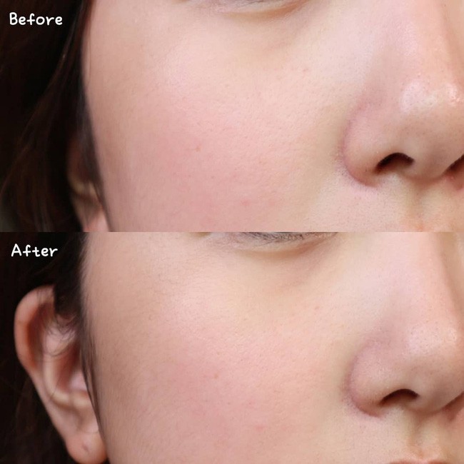 Làn da từ đầy tỳ vết thành mịn đẹp xuất sắc nhờ phương pháp peel da, nhưng không chú ý những điều sau thì hỏng bét-2