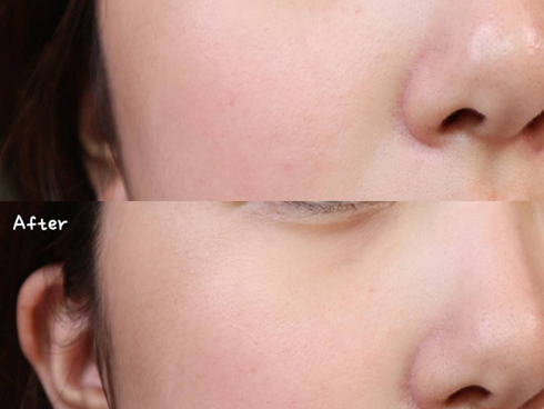 Kinh hãi hình ảnh cô gái bị nổi bóng nước khắp mặt vì làm đẹp: Chuyên gia cảnh báo điều quan trọng trước khi peel da-9