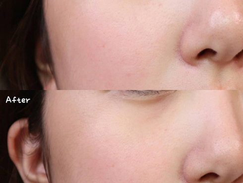 Làn da từ đầy tỳ vết thành mịn đẹp xuất sắc nhờ phương pháp peel da, nhưng không chú ý những điều sau thì