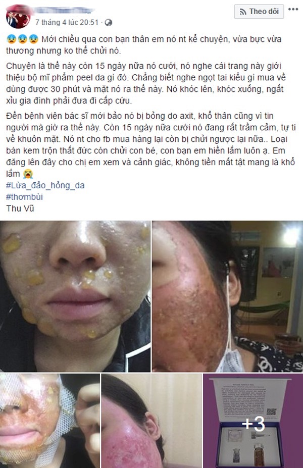 Kinh hãi hình ảnh cô gái bị nổi bóng nước khắp mặt vì làm đẹp: Chuyên gia cảnh báo điều quan trọng trước khi peel da-1
