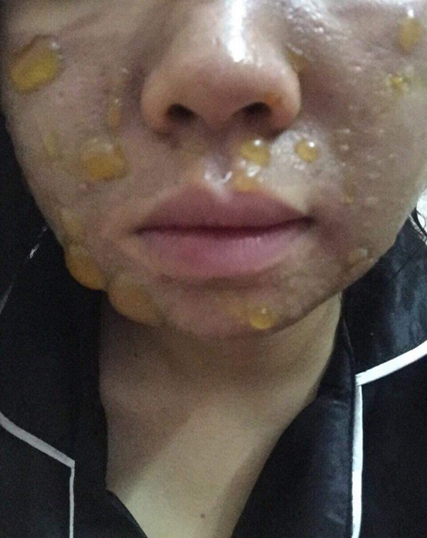 Kinh hãi hình ảnh cô gái bị nổi bóng nước khắp mặt vì làm đẹp: Chuyên gia cảnh báo điều quan trọng trước khi peel da-2