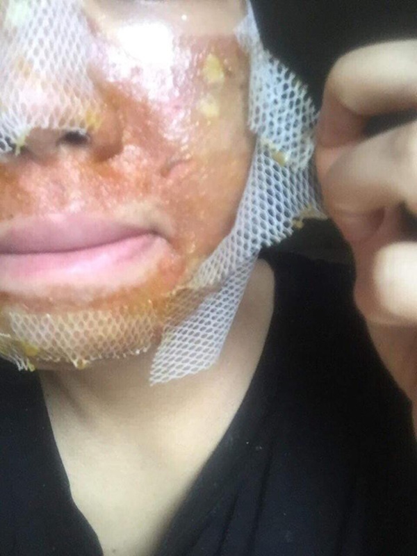 Kinh hãi hình ảnh cô gái bị nổi bóng nước khắp mặt vì làm đẹp: Chuyên gia cảnh báo điều quan trọng trước khi peel da-3