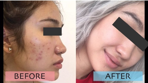 Kinh hãi hình ảnh cô gái bị nổi bóng nước khắp mặt vì làm đẹp: Chuyên gia cảnh báo điều quan trọng trước khi peel da-6