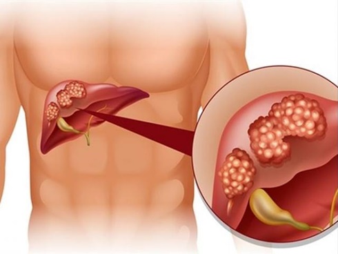 Gan yếu thì toàn thân mệt: 4 thực phẩm khiến gan phải làm việc quá sức mà sinh bệnh-6