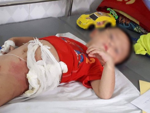 Người cậu ném cháu ruột vào đống lửa đã bị bắt, nạn nhân có thể phải chuyển lên tuyến trung ương điều trị