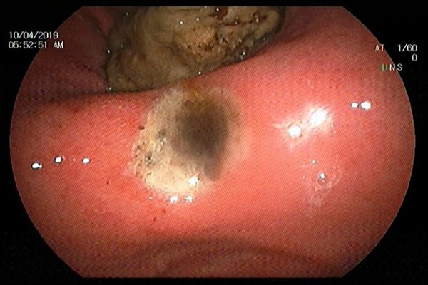 Uống bột nghệ sai cách, bác sĩ ngã ngửa khi thấy có khối bã thức ăn trong dạ dày người phụ nữ-2