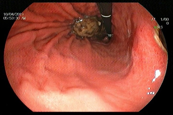 Uống bột nghệ sai cách, bác sĩ ngã ngửa khi thấy có khối bã thức ăn trong dạ dày người phụ nữ-3