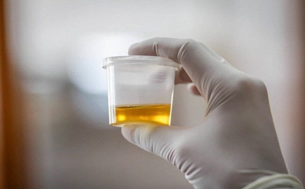 Nước tiểu đột ngột có dấu hiệu này, đừng lơ là vì nguy cơ đáng sợ đằng sau-1