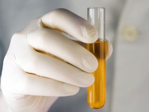 Người phụ nữ hỏng thận vĩnh viễn sau 1 tháng giảm cân theo cách nhiều chị em vẫn làm-3