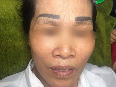 Xăm sai một li đi tận lên trán, người phụ nữ nhận về cặp lông mày