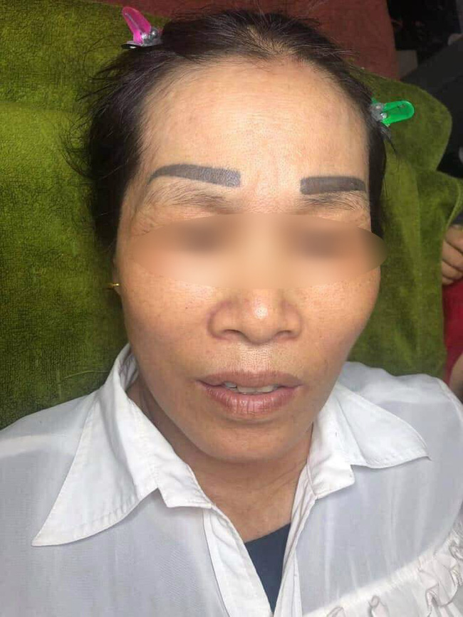 Xăm sai một li đi tận lên trán, người phụ nữ nhận về cặp lông mày tân dòng sông ly biệt hệt trò đùa-1