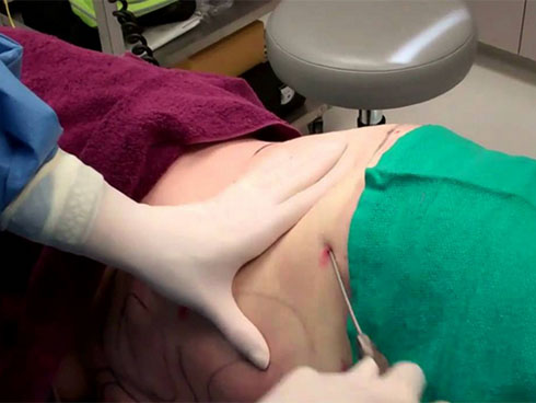 Nếu không muốn mất mạng vì hút mỡ bụng: Chuyên gia cảnh báo những điều cần nắm rõ trước khi quyết định thực hiện-6