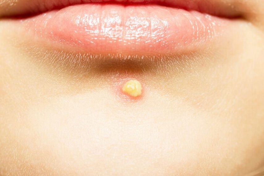 Trời chuyển hè là loại mụn đầu trắng lại bắt đầu làm khổ nhiều người, hãy học cách phòng tránh ngay-1