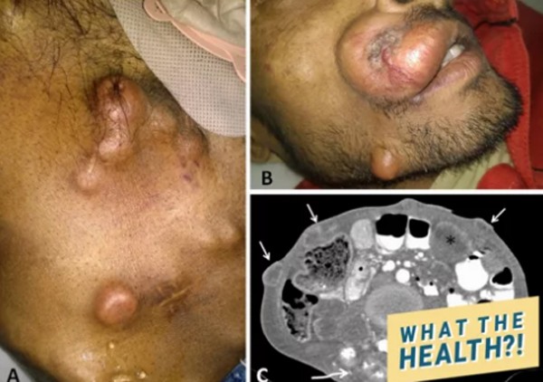 Người đàn ông tử vong do ung thư đại trực tràng nhưng dấu hiệu cảnh báo trước đó mới là điều mọi người cần cảnh giác-1