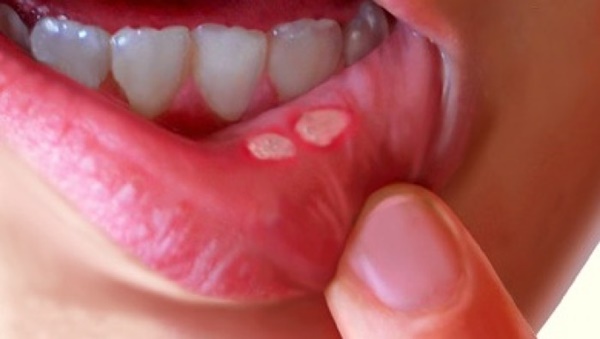 12 cách chữa căn bệnh nhiệt miệng đáng ghét-1