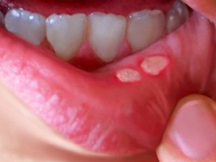 12 cách chữa căn bệnh nhiệt miệng đáng ghét