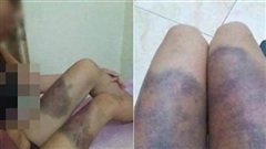 Cô gái mang thai 6 tháng tuổi bị bắt cóc, tra tấn khiến thai nhi tử vong ở Sài Gòn-1