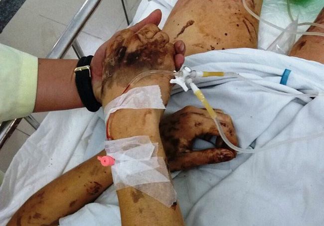 Vụ Việt kiều Canada bị tạt axit, cắt gân chân: Nạn nhân sống trong sợ hãi, hung thủ vẫn bí ẩn-1