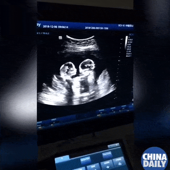 Từ trong bụng mẹ đã đánh nhau ầm ầm, cặp đôi song sinh chưa chào đời đã nổi tiếng khắp MXH-1