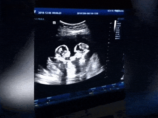 Từ trong bụng mẹ đã đánh nhau ầm ầm, cặp đôi song sinh chưa chào đời đã nổi tiếng khắp MXH-2