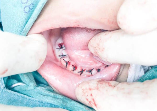 Cậu bé 4 tuổi phải nhổ 18 chiếc răng vì cha mẹ quên làm điều này-3