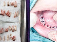 Cậu bé 4 tuổi phải nhổ 18 chiếc răng vì cha mẹ quên làm điều này
