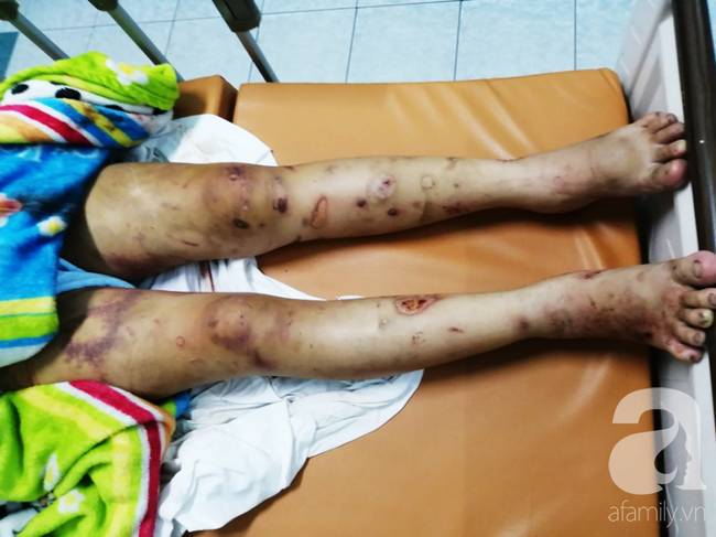 Cô gái mang bầu 6 tháng bị bắt cóc, tra tấn đến sảy thai bị sang chấn tâm lý, la hét, kích động trong bệnh viện-2