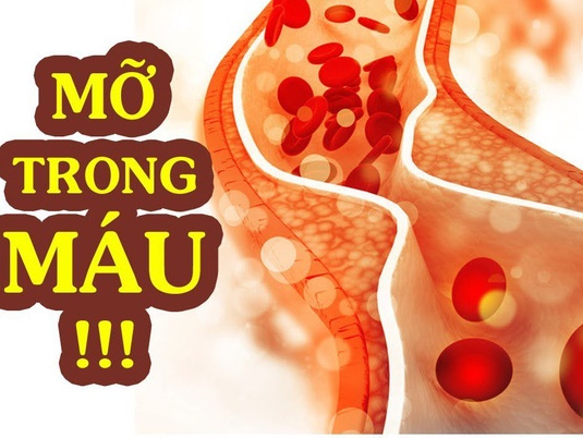 Cứ mắc 1 trong 4 dấu hiệu sau thì coi chừng mỡ máu đang tăng vọt, không vào viện ngay sẽ nguy hiểm đến tính mạng-4