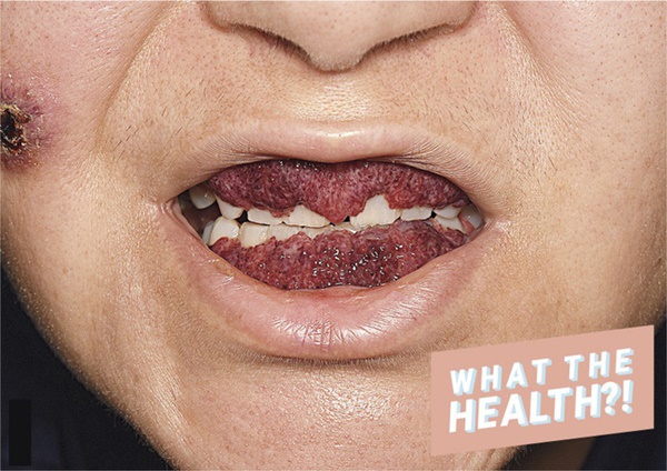 Hình ảnh lan truyền cho thấy căn bệnh hiếm gặp khiến lợi của phụ nữ trông giống hệt quả dâu tây dát vào-1