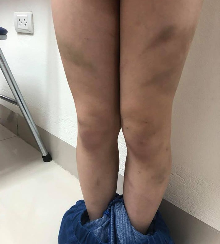 Mẹ ruột tố con trai lớp 1 bị mẹ kế bạo hành bằng dép và gậy khiến bé bầm tím cả người-2