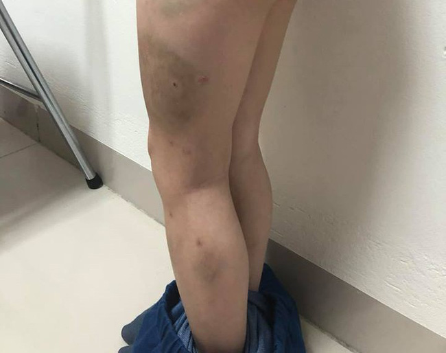 Mẹ ruột tố con trai lớp 1 bị mẹ kế bạo hành bằng dép và gậy khiến bé bầm tím cả người-3