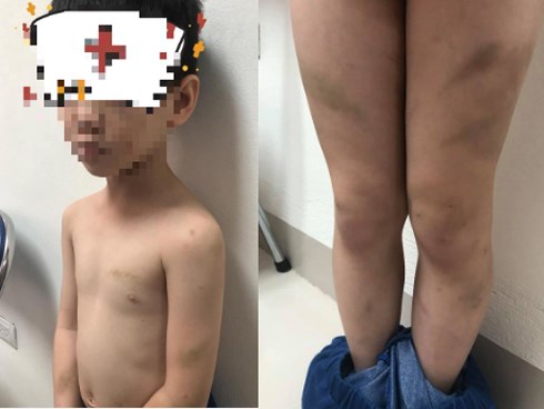 Mẹ ruột tố con trai lớp 1 bị mẹ kế bạo hành bằng dép và gậy khiến bé bầm tím cả người