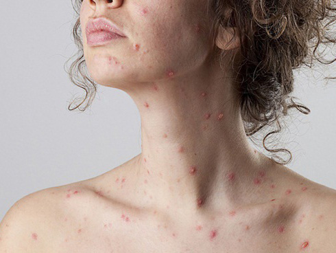 Hà Nội yêu cầu 10 quận, huyện tăng cường công tác phòng, chống bệnh sởi-2