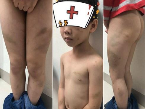 Bác sỹ Bệnh viện Việt Đức và vợ kế bị tố bạo hành con trai bầm tím khắp người